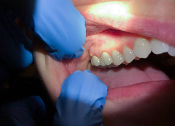 Best Emergency Treatment for Dental Infections or Abscesses in Sioux City, IA
